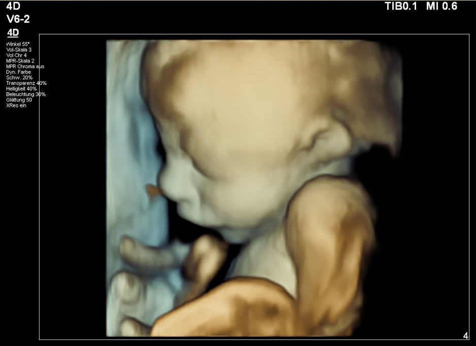 4D Ultraschallbild